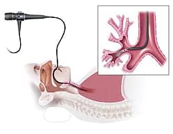 Bronchial Thermoplasty: A New Bronchoscopic Treatment for Severe Asthma