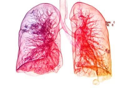 Therapeutic Exercise Lessens Lung Injury and Muscle Wasting in ARDS Patients