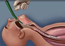 AirwayMgmt NJRmed_NoBiteV_225