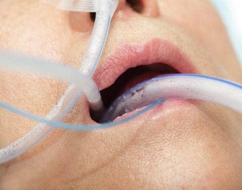 Ventilator-associated Pneumonia: They’ve Zapped VAP