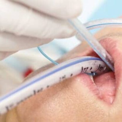 vap in Intubation and VAP: Complex Condition, Bundled Solutions