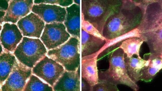 Images Reveal How Lung Cancer Cells Spread