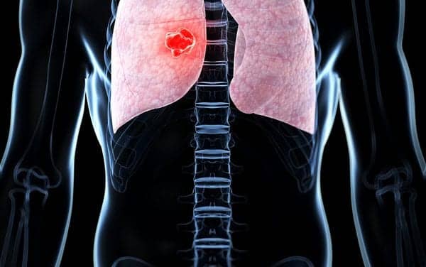 IMRT Linked to Better Tolerance of Chemotherapy in Lung Cancer Patients