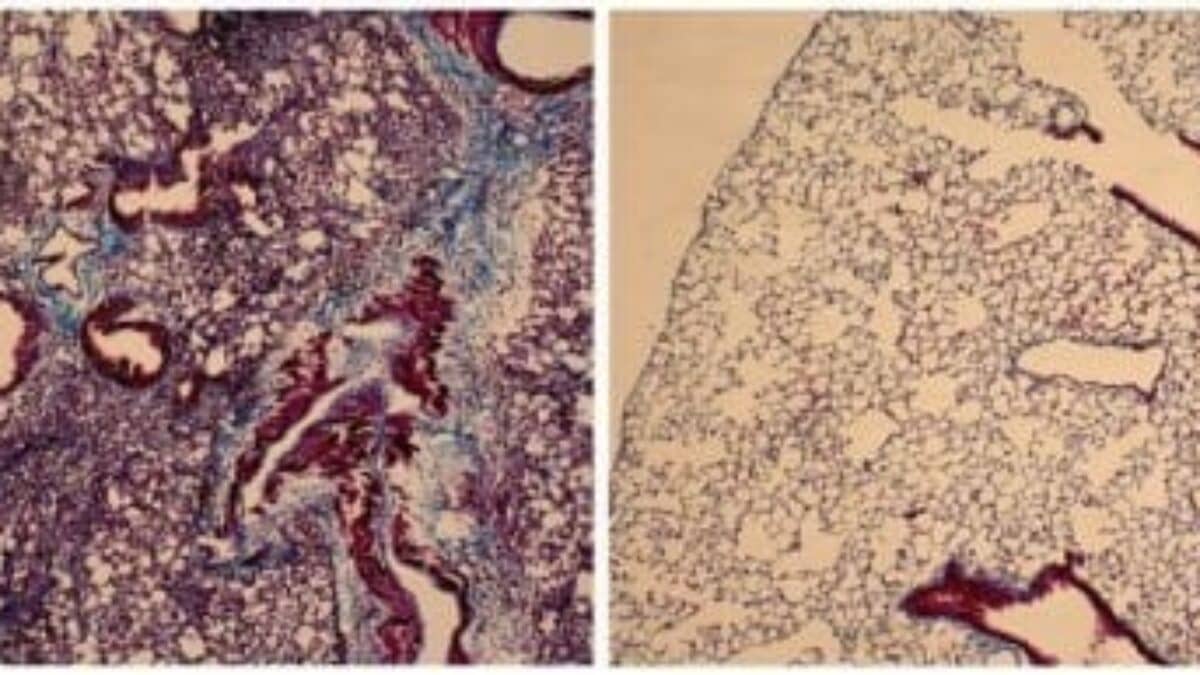 M10 Peptide Reverses Fibrotic Damage in Interstitial Lung Disease Model
