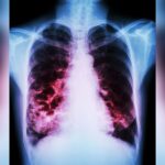 Comorbid Bronchiectasis + Diabetes Tied to Worse Outcomes