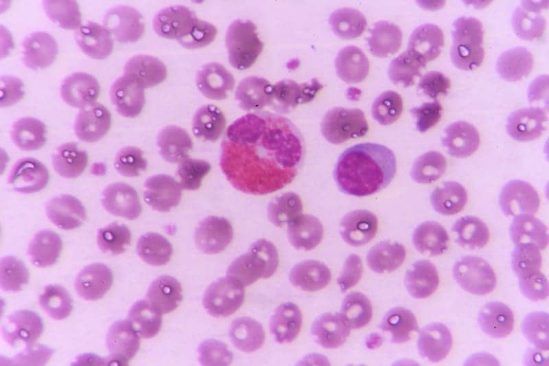 Blood Eosinophil Counts Linked to Adverse Pneumonia Events in COPD Patients