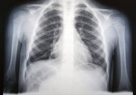 New Target for Pneumonia Seems to Restore Tight Barriers and Fluid Clearance in the Lungs