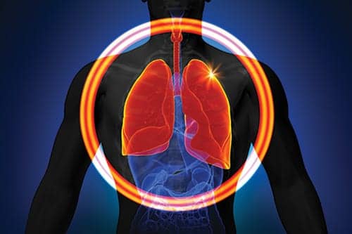 Interstitial Lung Diseases