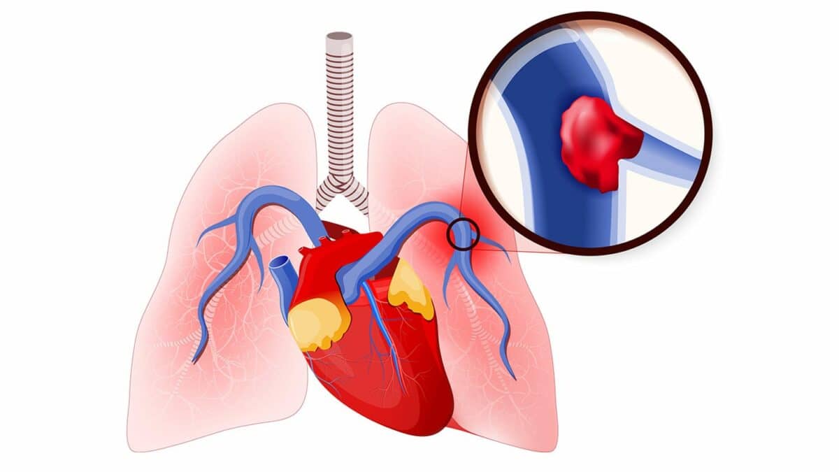Smokers Have More Readmissions for Pulmonary Emboli