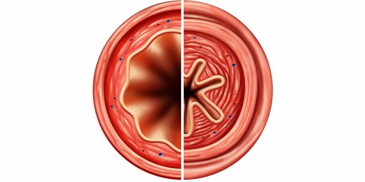 Worm Larval Protein Could Suppress Inflammation in Allergic Asthma