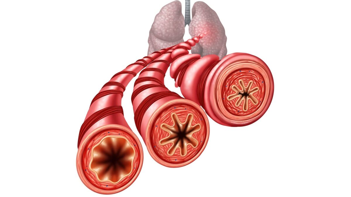 glutathione lungs asthma do steroidal inhalers lower levels & COPD Treatment Specialist Near Me in Charleston, SC Glutathione Oxidation Is Associated With  Newly ID'd Molecules Tied to