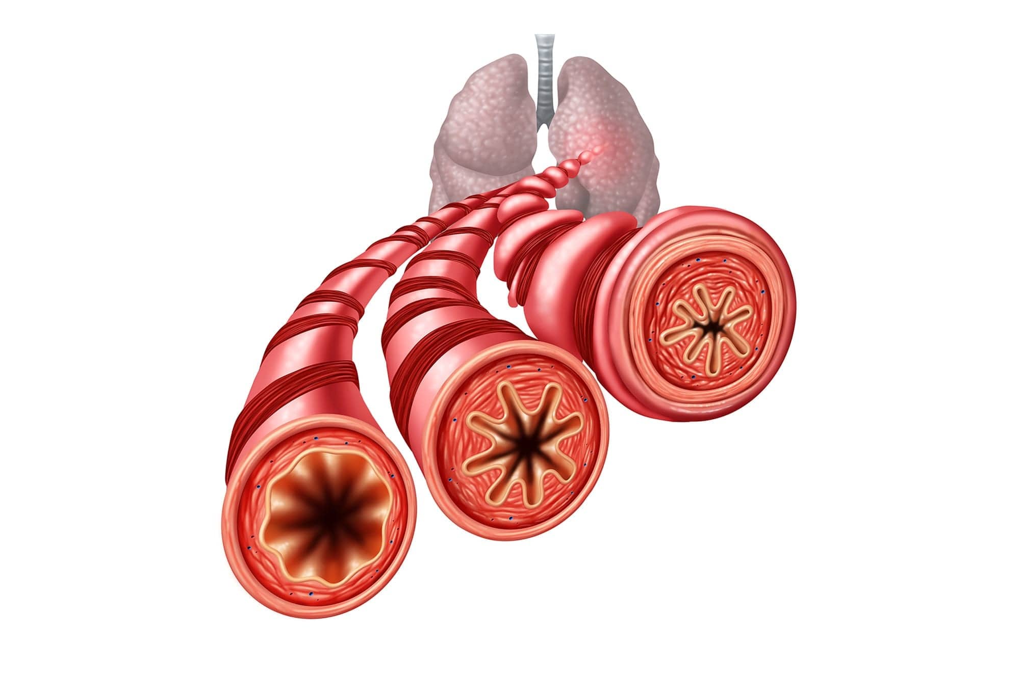 inhaled glutathione for asthma I am using a steroid inhaler for asthma. Does it cause any issues? main image 1