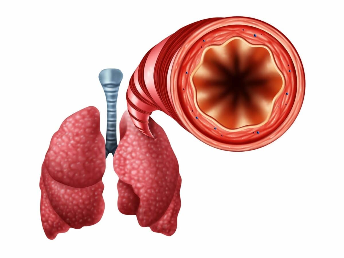 New Research Links Iron to Asthma-Linked Airway Inflammation, Offering Hope for Novel Treatments
