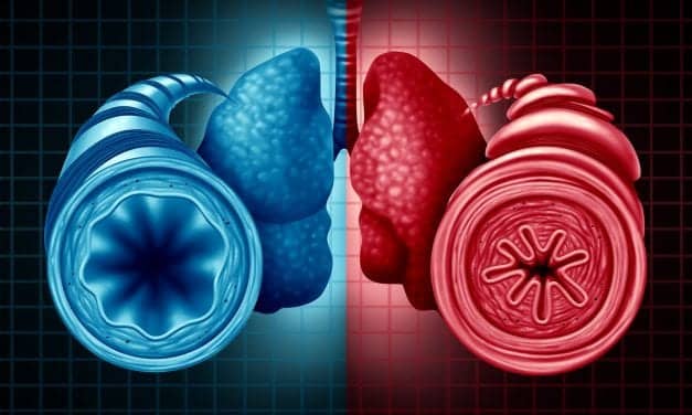 Tezepelumab Reduced Exacerbation Rates in severe Asthma 77%