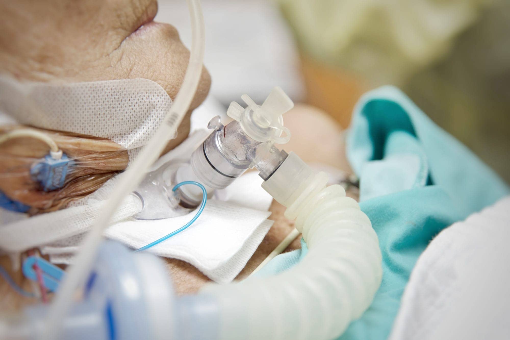 Early Tracheostomy Not Associated with Improved Survival RT