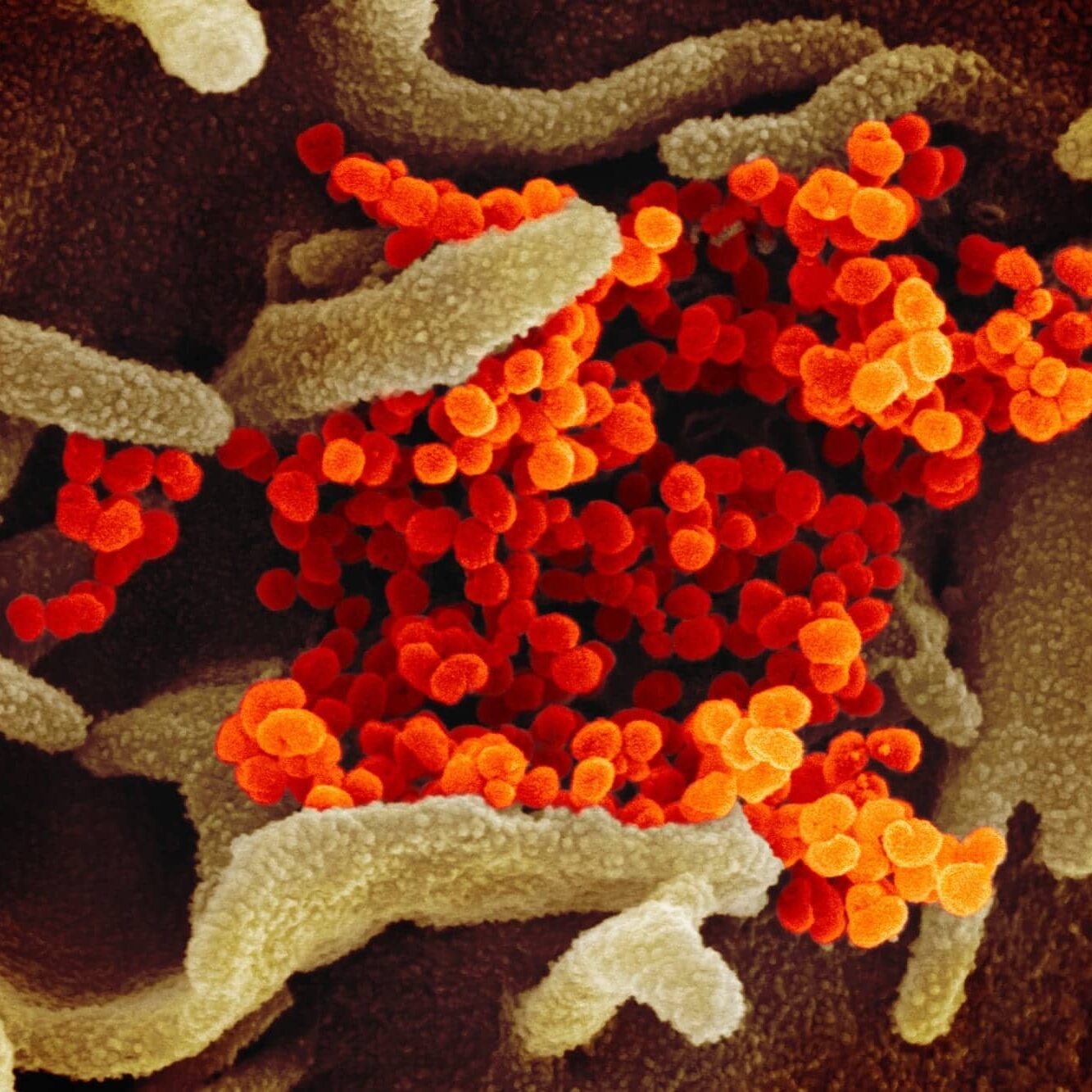 First Case of Flu and COVID-19 Co-infection Confirmed | Respiratory Therapy