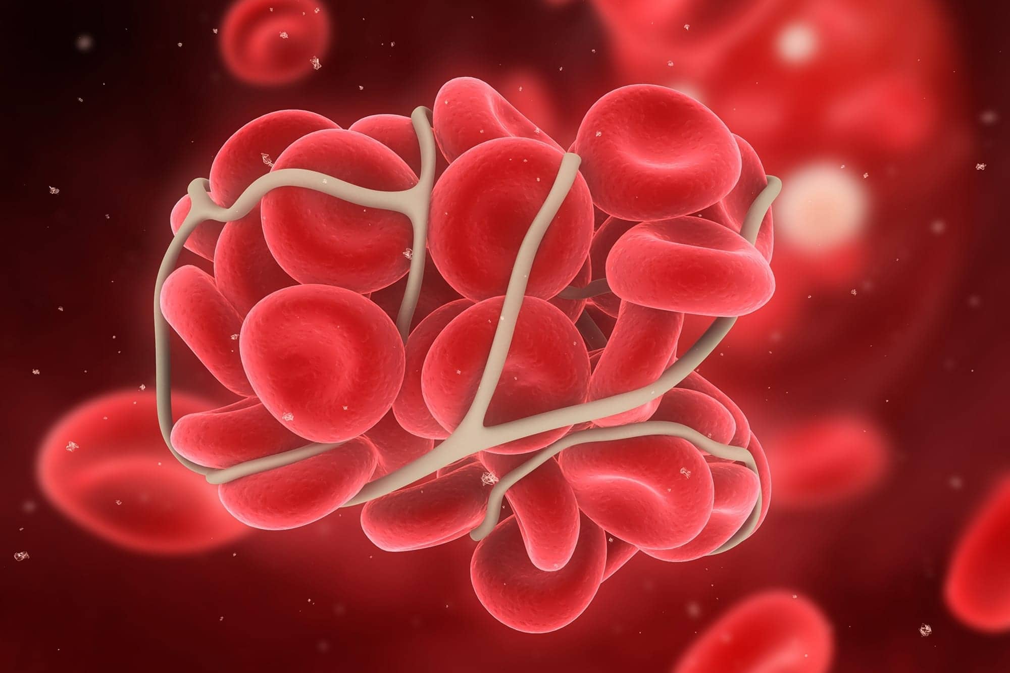 Pulmonary Embolism as Common in Children as Adults
