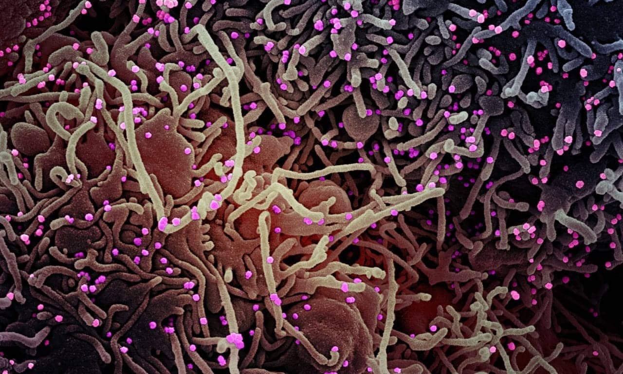 Cases of ME/CFS Increase Following COVID-19