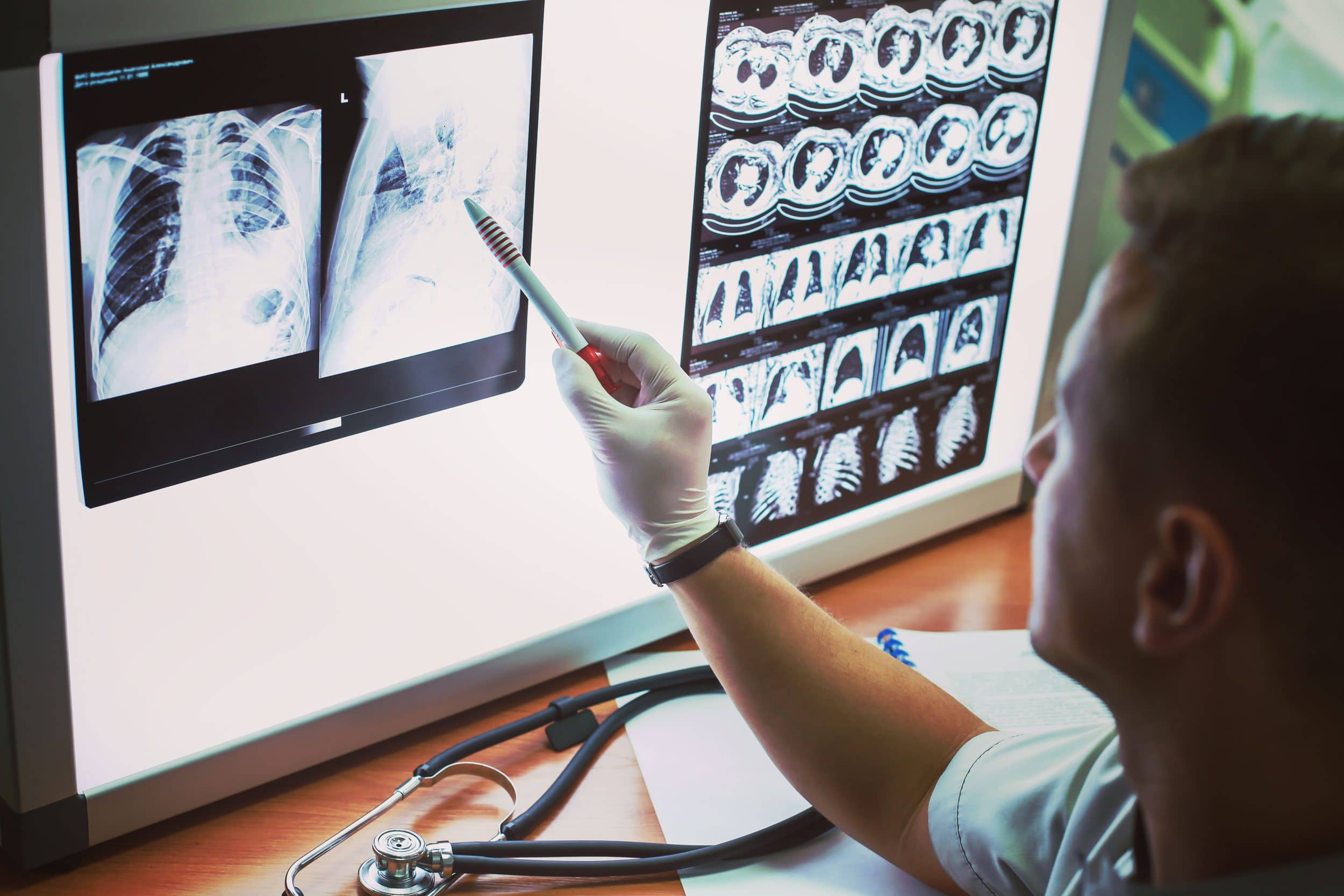 Ai Matches Radiologists in Detecting Pulmonary Embolism