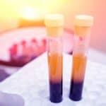 Plasma Tests for Fungal Infections and Pneumonia