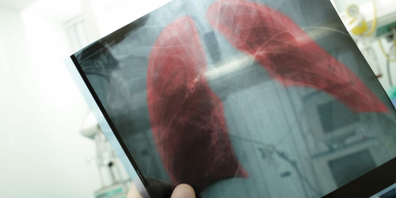 Aerosolized mRNA Pneumonia Treatment Improved Symptoms in Preclinical Study