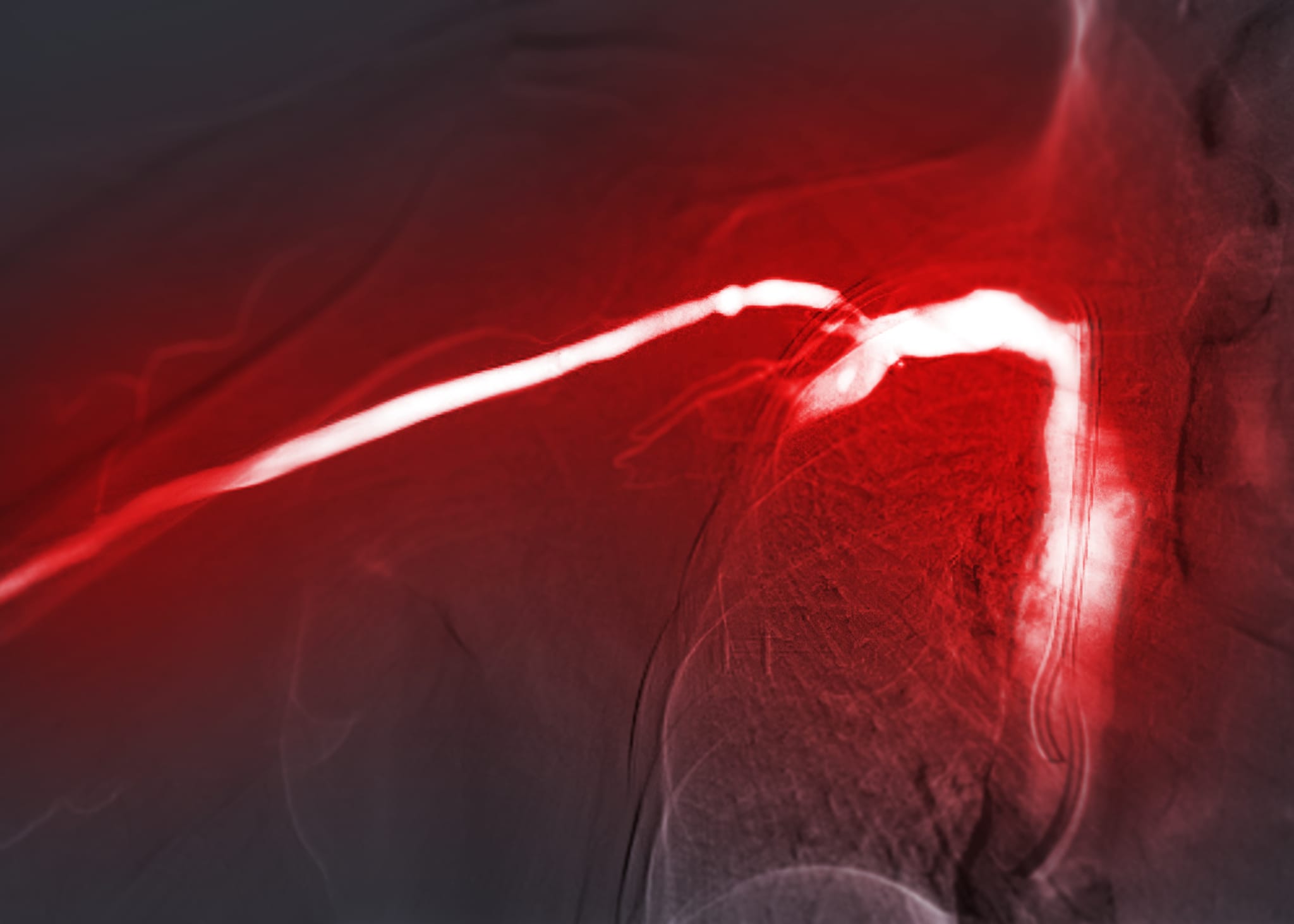 Complications for Balloon Technique for CTEPH Patients Dip