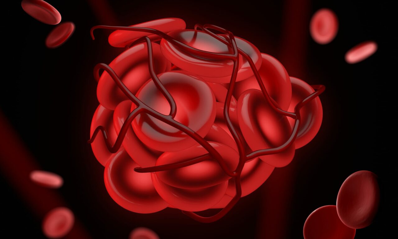 Indefinite Anticoagulation for VTE Lacks Mortality Benefits, Cost-effectiveness