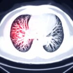 Pulmonary Embolism Death Rates Defy Medical Advancements