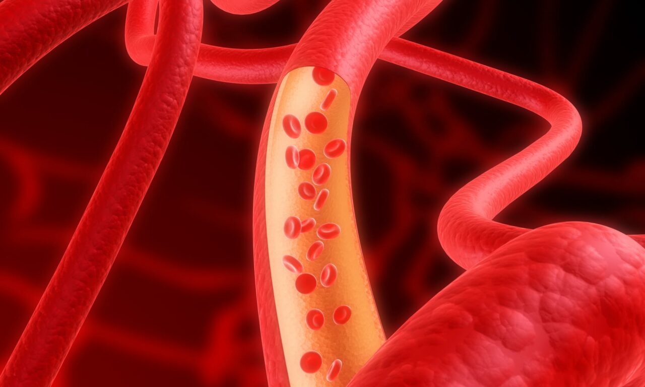 Pulmonary Artery Denervation Had Clinical Benefits in Pulmonary Hypertension
