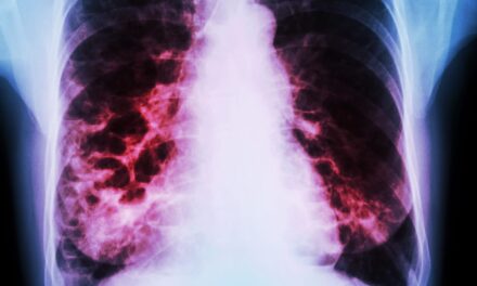 Suspected Bronchiectasis Tied to Higher Mortality, Even Without COPD