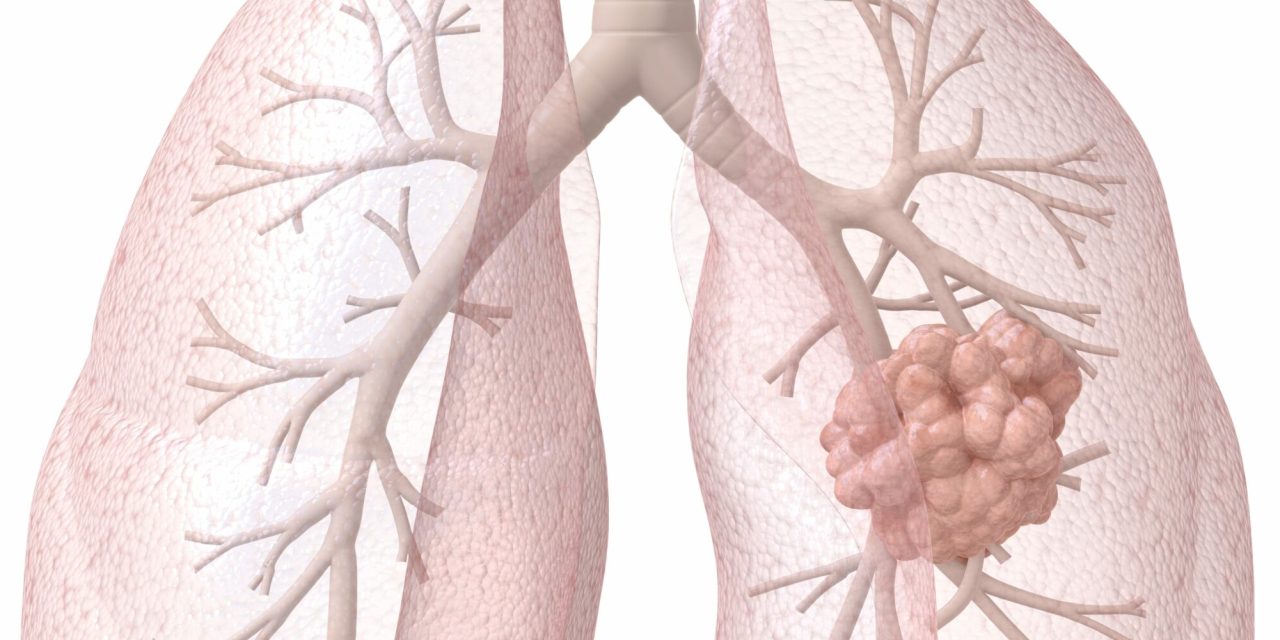 Deleting Key Protein Prevents Small Cell Lung Cancer in Murine Study