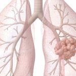 Smart Biopsy Tool Technology Improves Lung Cancer Detection