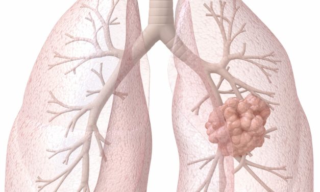 FDA Approves AstraZeneca’s Lung Cancer Drugs