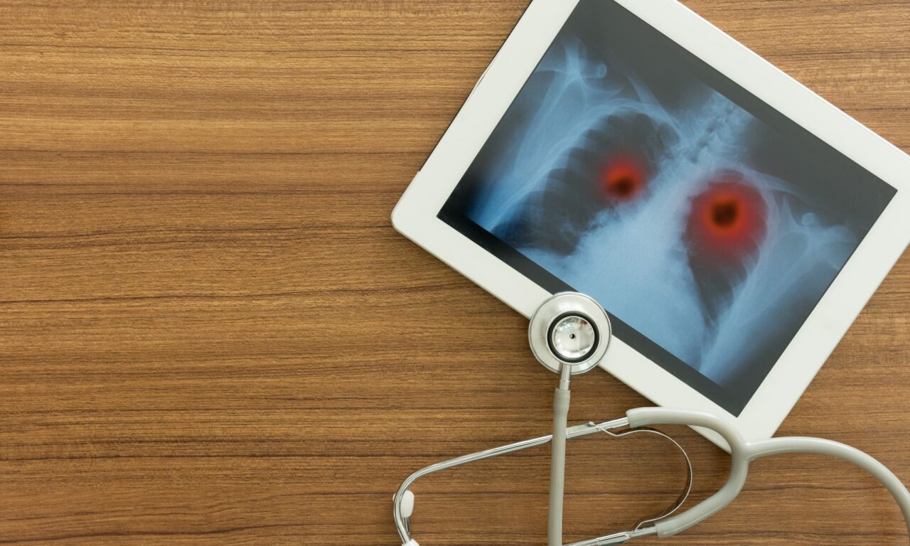 New Lung Cancer Screening Guideline Expands Eligibility