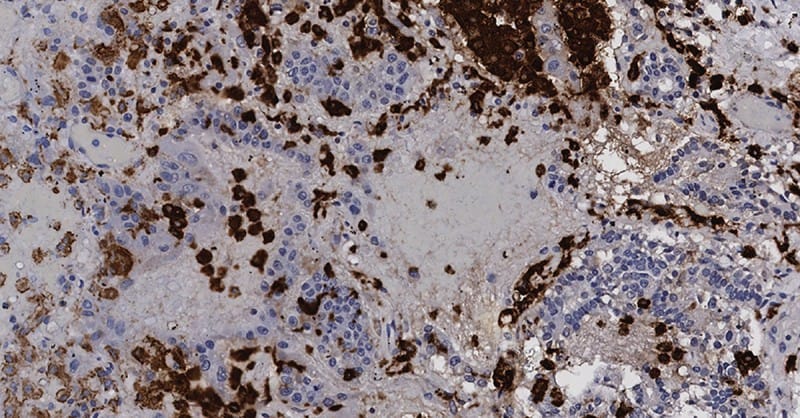 Cancer Drug Candidate Shows Promise in Preventing COVID-19 Lung Damage