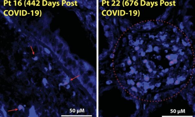 Virus Lurks in Long COVID Patients’ Guts for Years