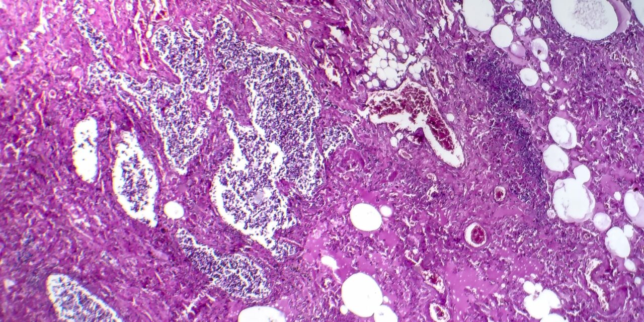 FDA Grants Orphan Drug Status to Lung Cancer Antibody-Drug Conjugate