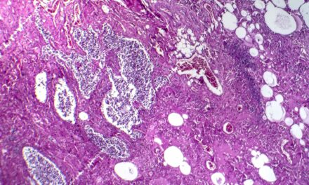 FDA Grants Orphan Drug Status to Lung Cancer Antibody-Drug Conjugate