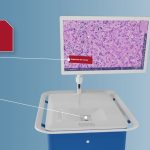 FDA Grants Breakthrough Status to AI Tool for Lung Cancer Biopsy Support