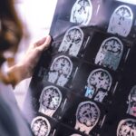 Sleep Apnea Linked to Increased Brain Growth