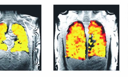 MRI with Perfluoropropane Gas Reveals Real-Time Effects of Treatment on Lung Function