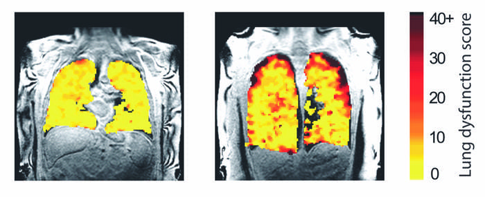 Mri With Perfluoropropane Gas Reveals Real-time Effects Of Treatment On 