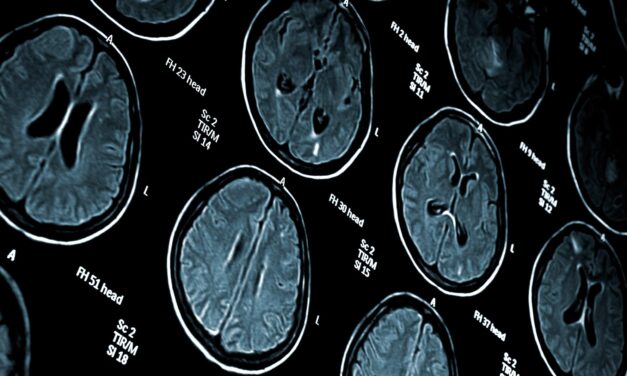 Sickle Cell Disease Tied to Older-Looking Brains
