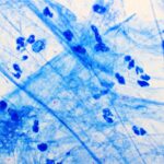 New Therapy Benefitted Some Drug-resistant TB Patients