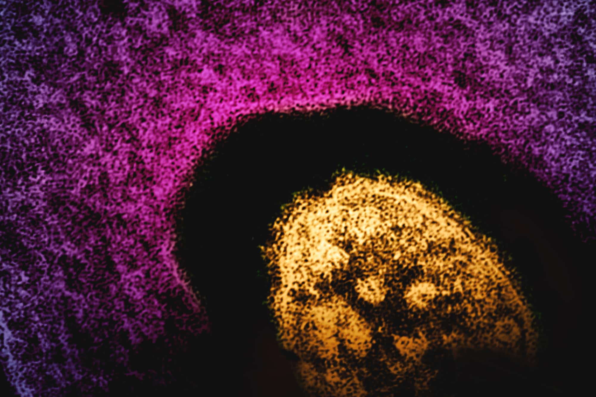 South Carolina Measles Outbreak Nears 800 Cases