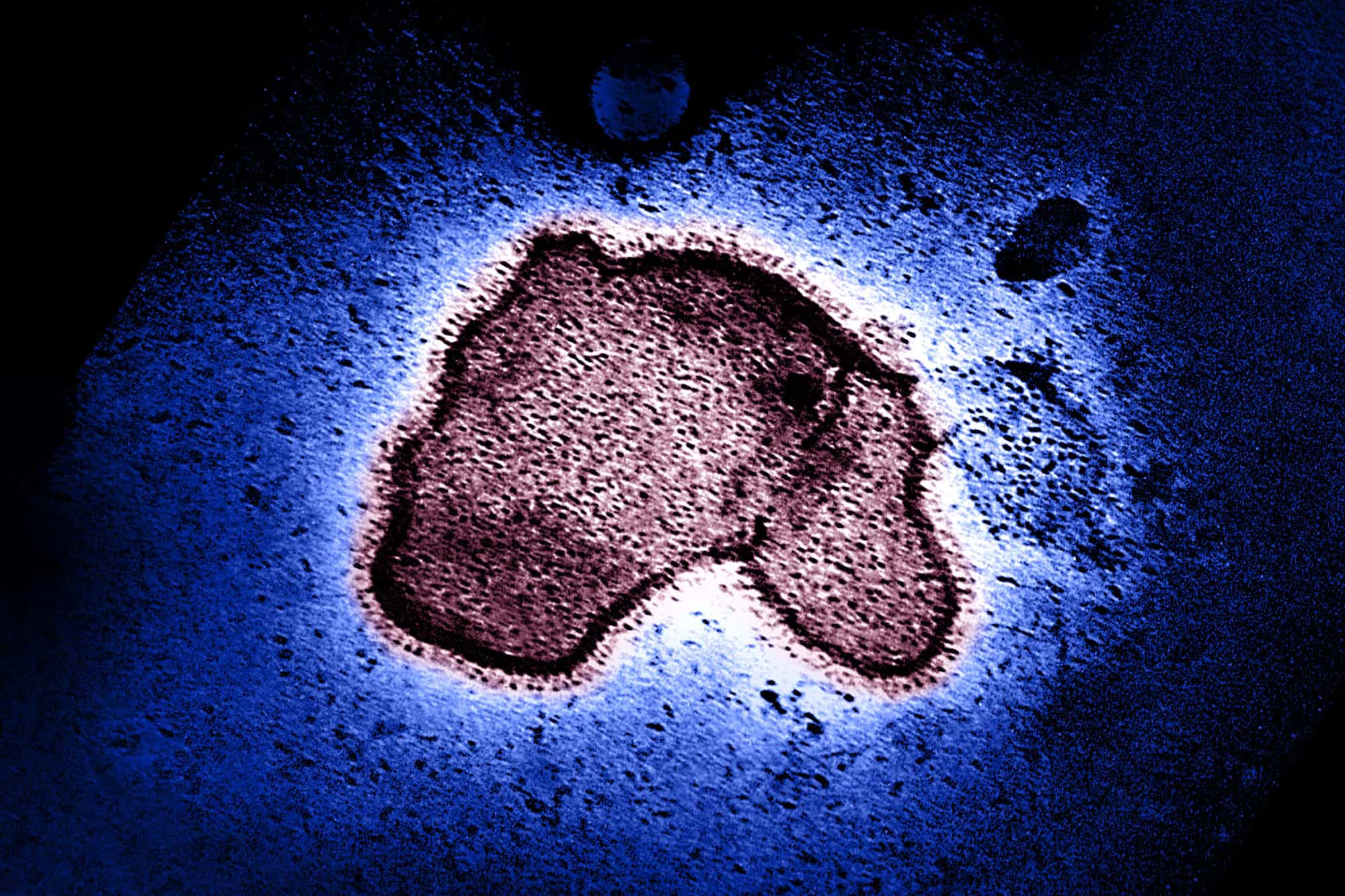 Nirsevimab Greatly Reduced Severe RSV in Infants