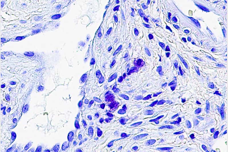 Credit: UC San Diego Health Sciences This image shows a section of sinus tissue with mast cells accumulating in the center (purple). A new study from UC San Diego has found that Veterans with chronic rhinosinusitis from airborne toxins accumulate more of these cells than others with the disease, suggesting the existence of a new biological subtype of this common disease.